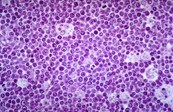 linfoma difuso de celulas B grandes